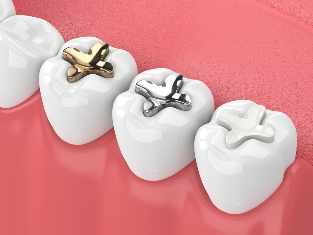 Illustration of a row of teeth with different fillings applied