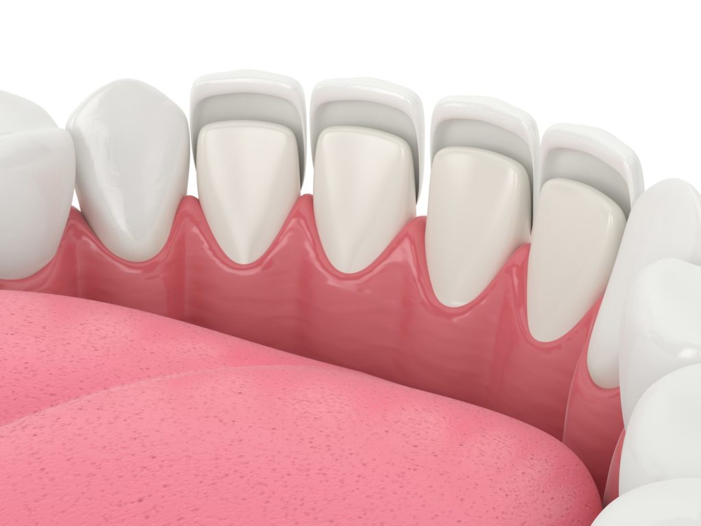 Illustration of a bottom row of teeth with dental veneers being attached