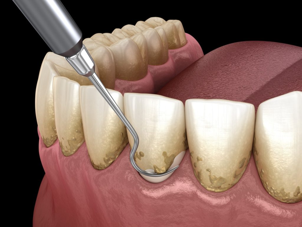 Illustration of a bottom row of teeth with a dental pick scraping plaque off them
