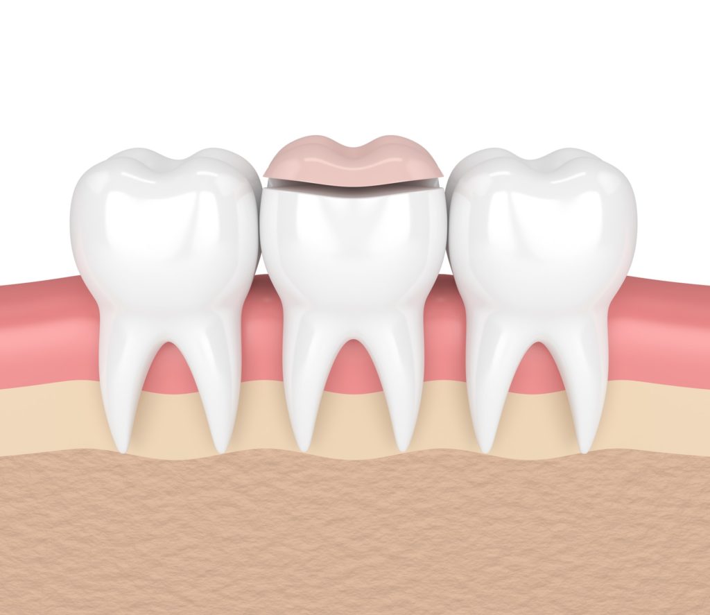 Illustration of a row of three teeth with a dental inlay being applied to the middle tooth
