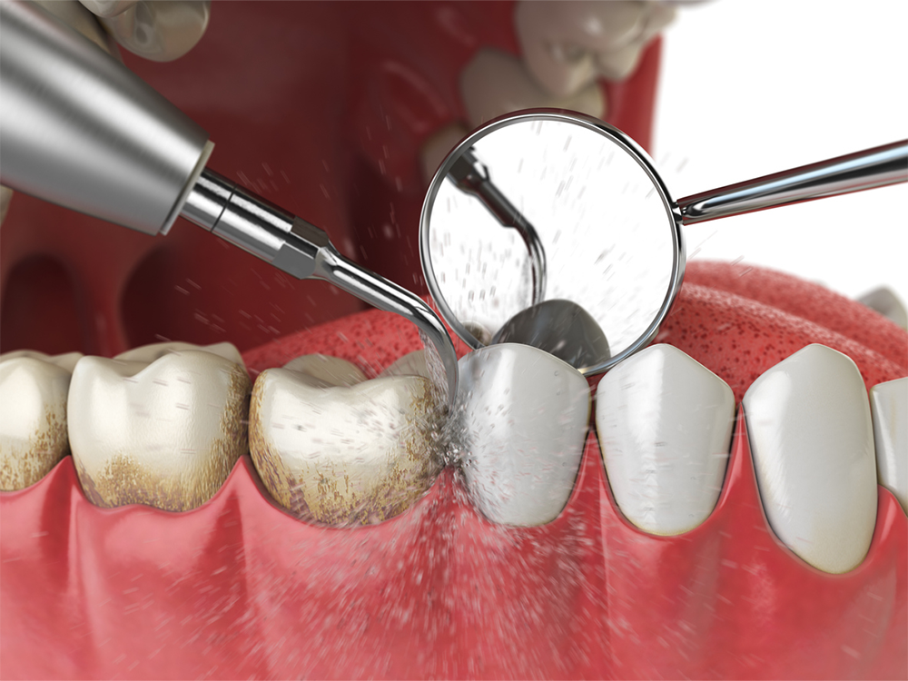 Graphic of plaque being scraped off of teeth, something done during a teeth cleaning at a regular dental checkup.