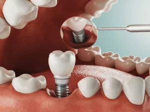 Illustration of a bottom row of teeth with a dental implant being inserted