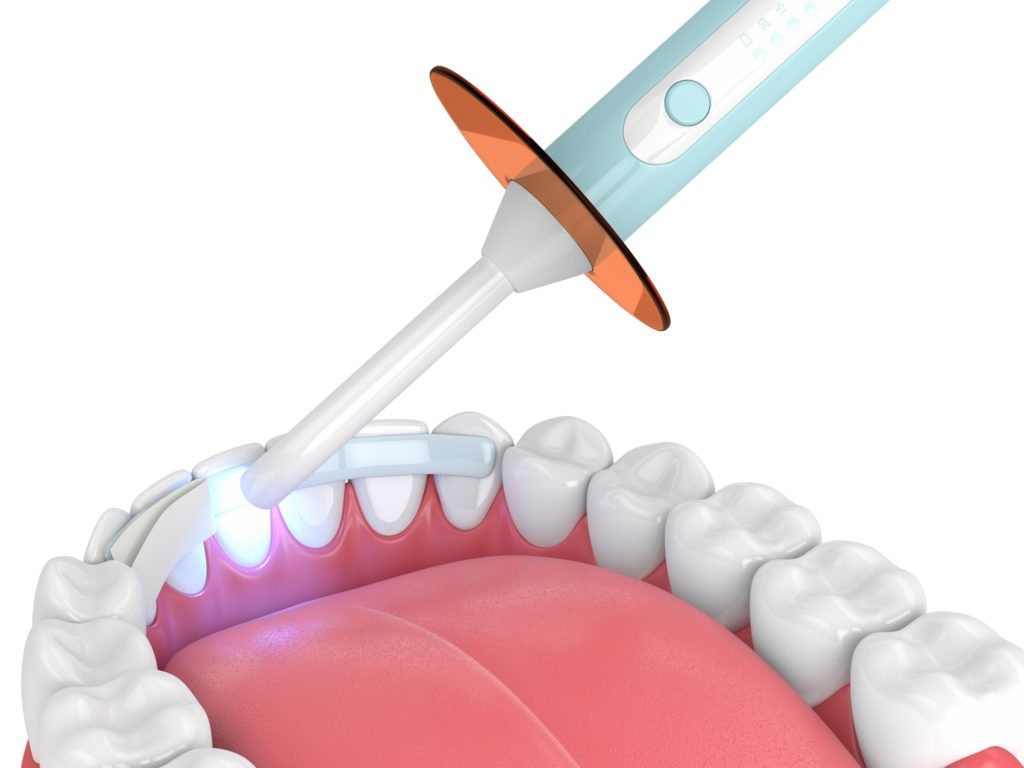 Illustration of a bottom row of teeth with dental bonding being attached