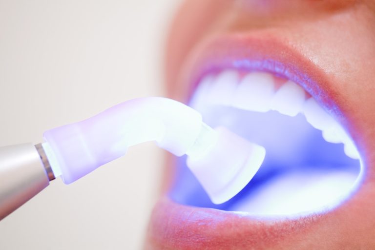 A dental laser shining its light into an open mouth