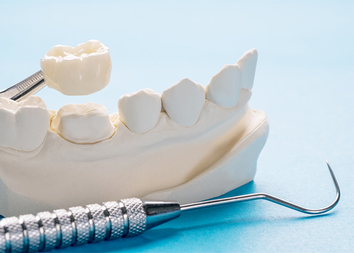 impression of teeth and a crown next to a dental tool