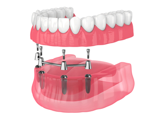 3D illustration of implant‑supported denture system showing lower jaw with metal implants and abutments connected to removable denture, upper denture displayed separately above.